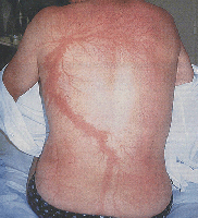 Rückenzeichnung durch einen Blitzschlag Blitzschlag